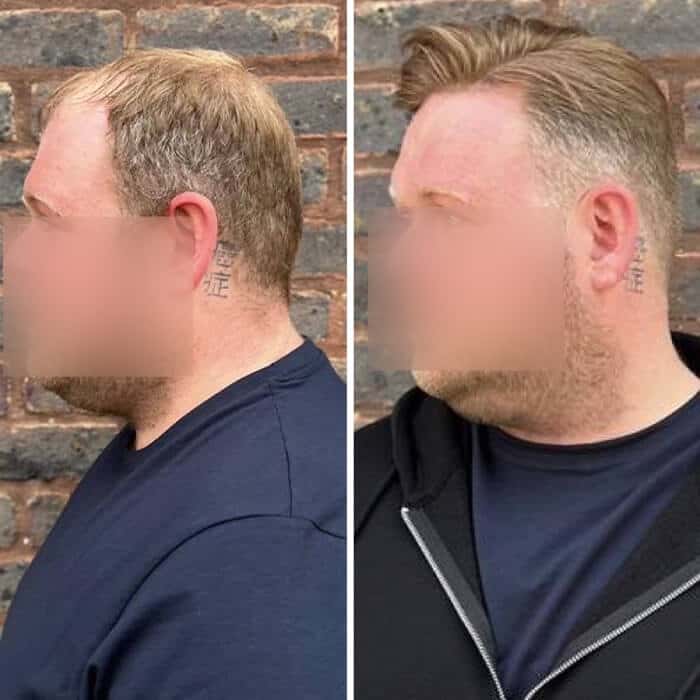 Man with a full head of hair after non-surgical replacement