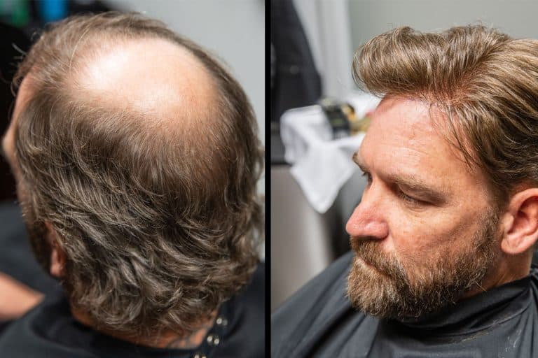 Before and after men's hair restoration