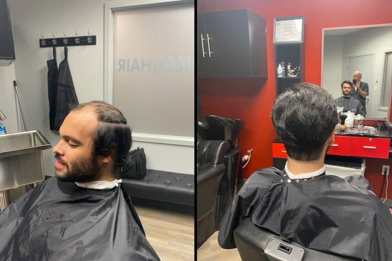 Before and after hair replacement result
