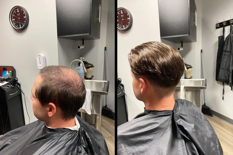 Before and after men's hair restoration