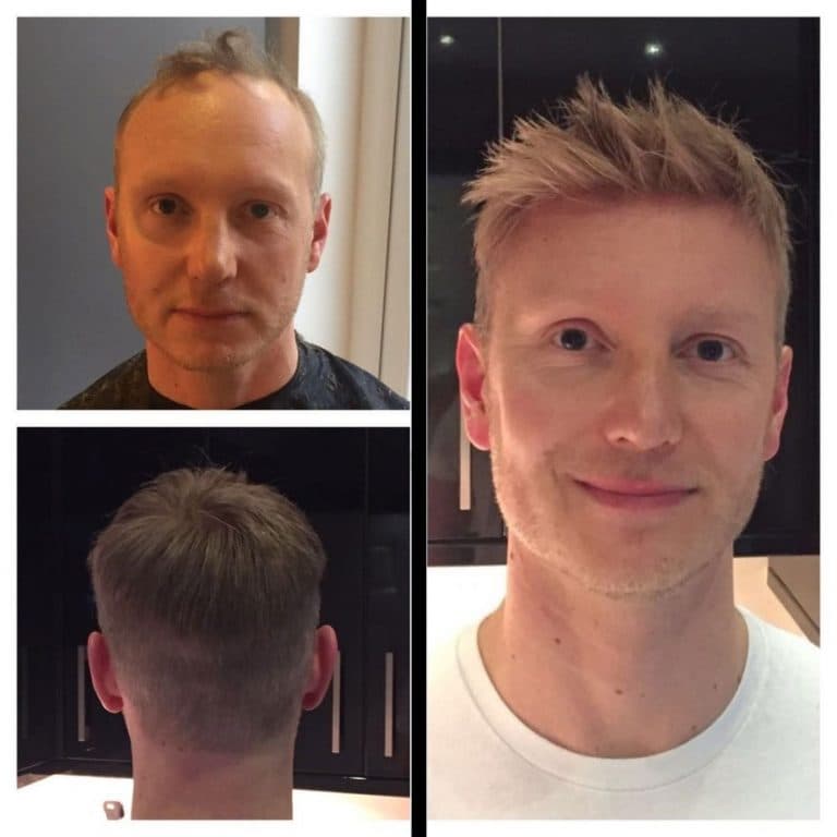 Before and after custom hair system