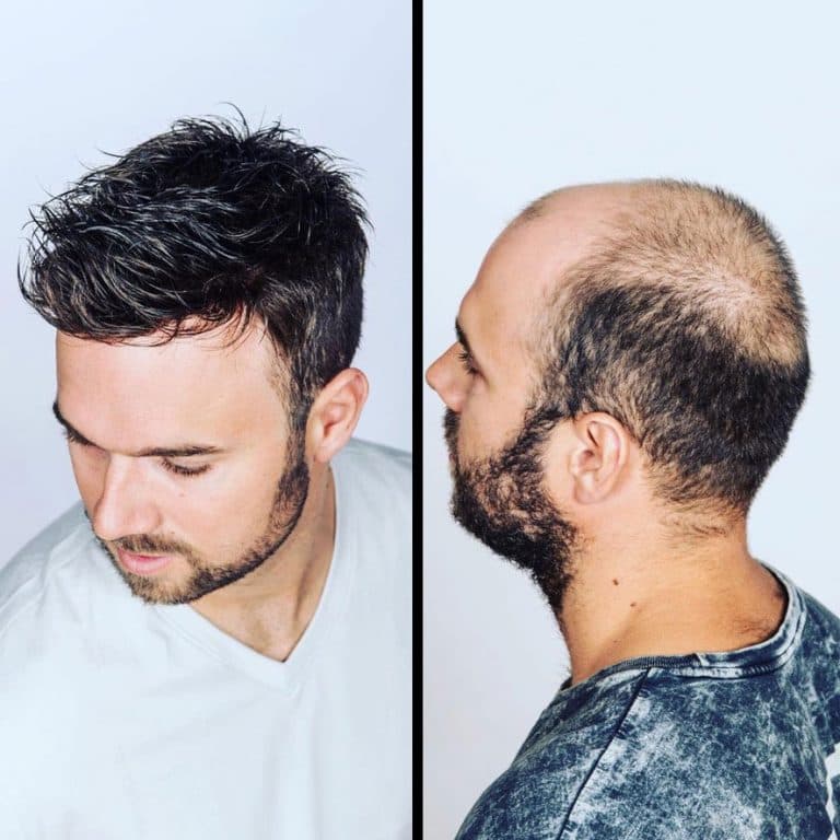 Before and after men's hair restoration
