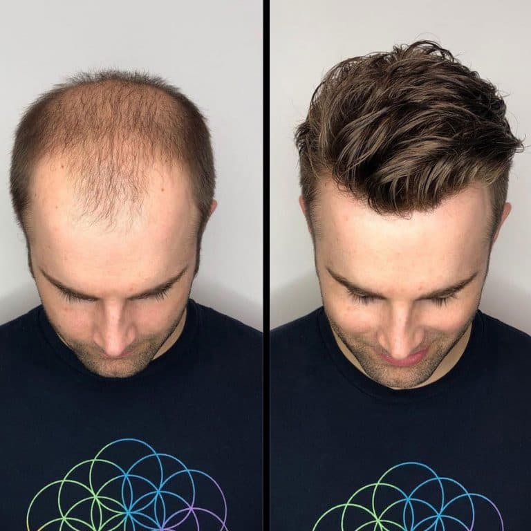 Before and after hair system transformation