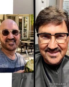Before and after hair replacement