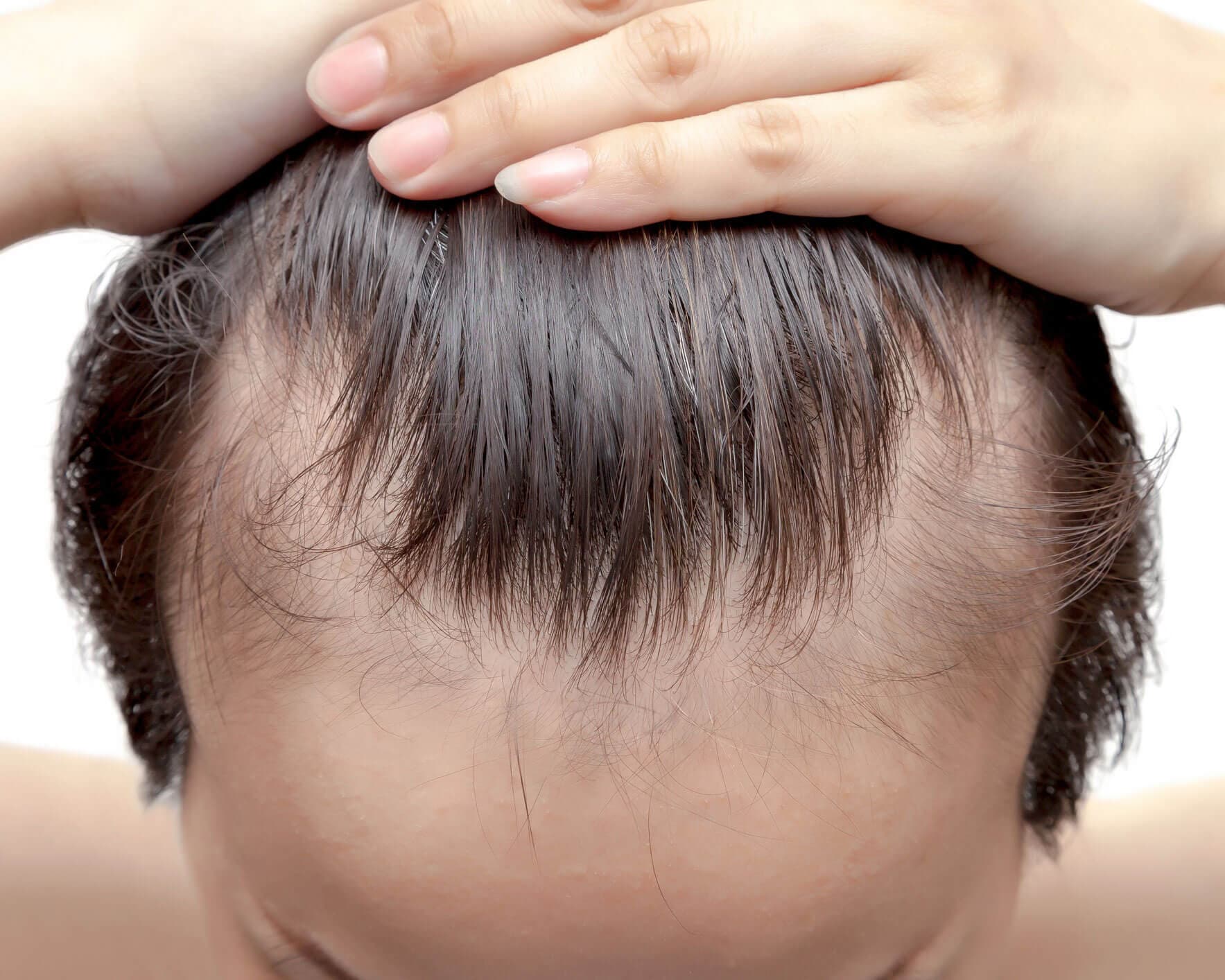 Choosing Receding Hairline Solutions in Jacksonville