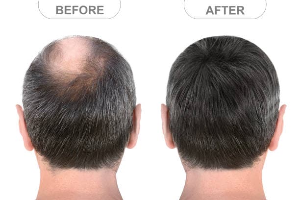 Before and after hair system reattachment