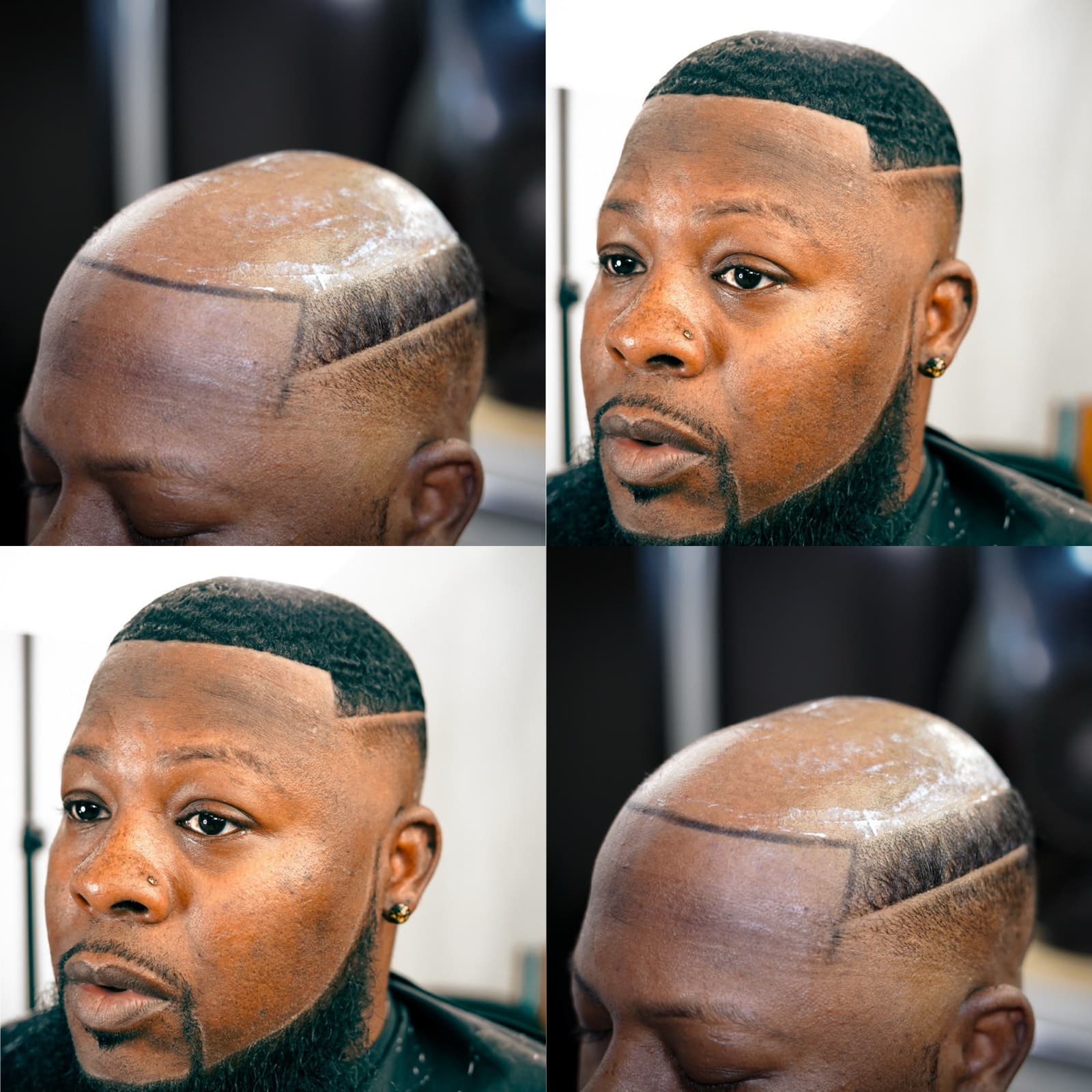 ManHair client: real human hair replacement result
