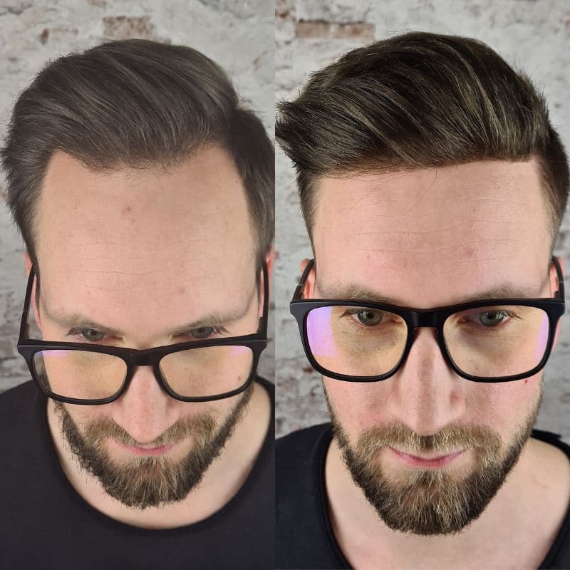 Hairline hair system, before and after
