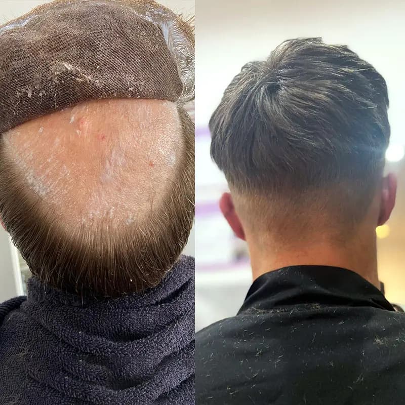 Men's Hair Replacement Systems