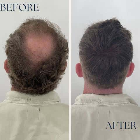 Side profile of a man with a full hair system