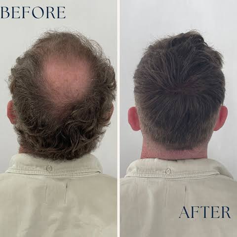 Before and after a men's hair replacement system on the crown