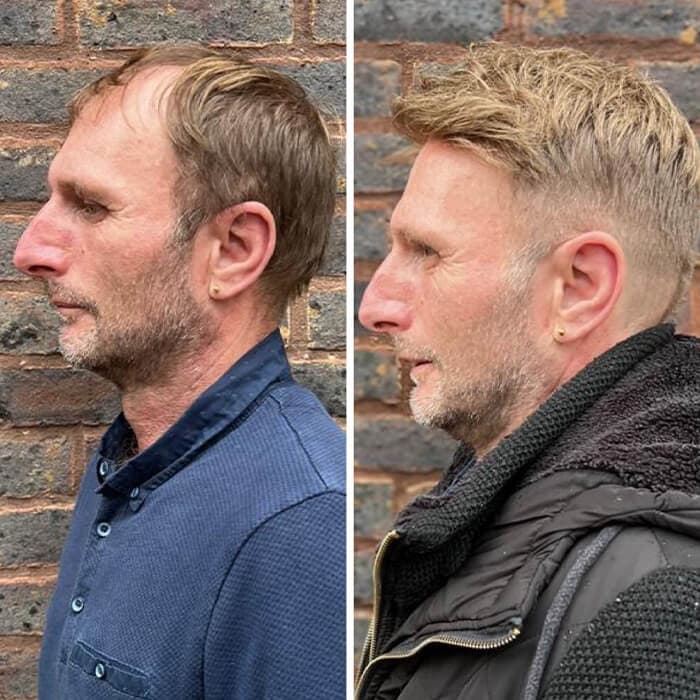 Before and after a men's hair replacement system in profile
