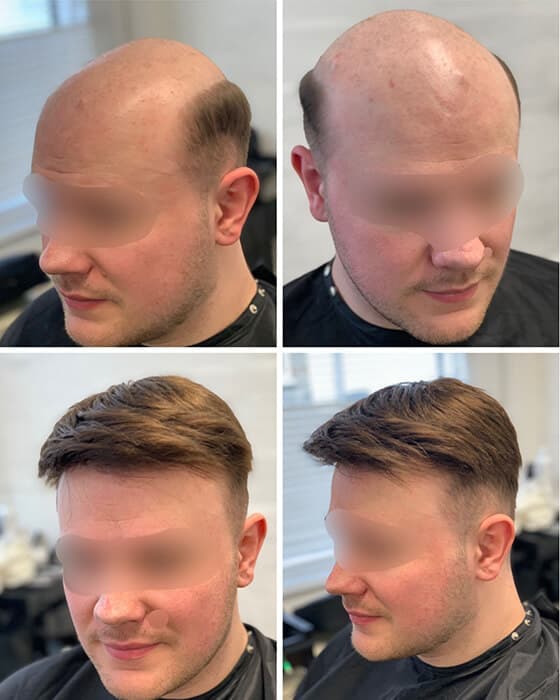 Can Hair Loss be a Sign of Something Serious?