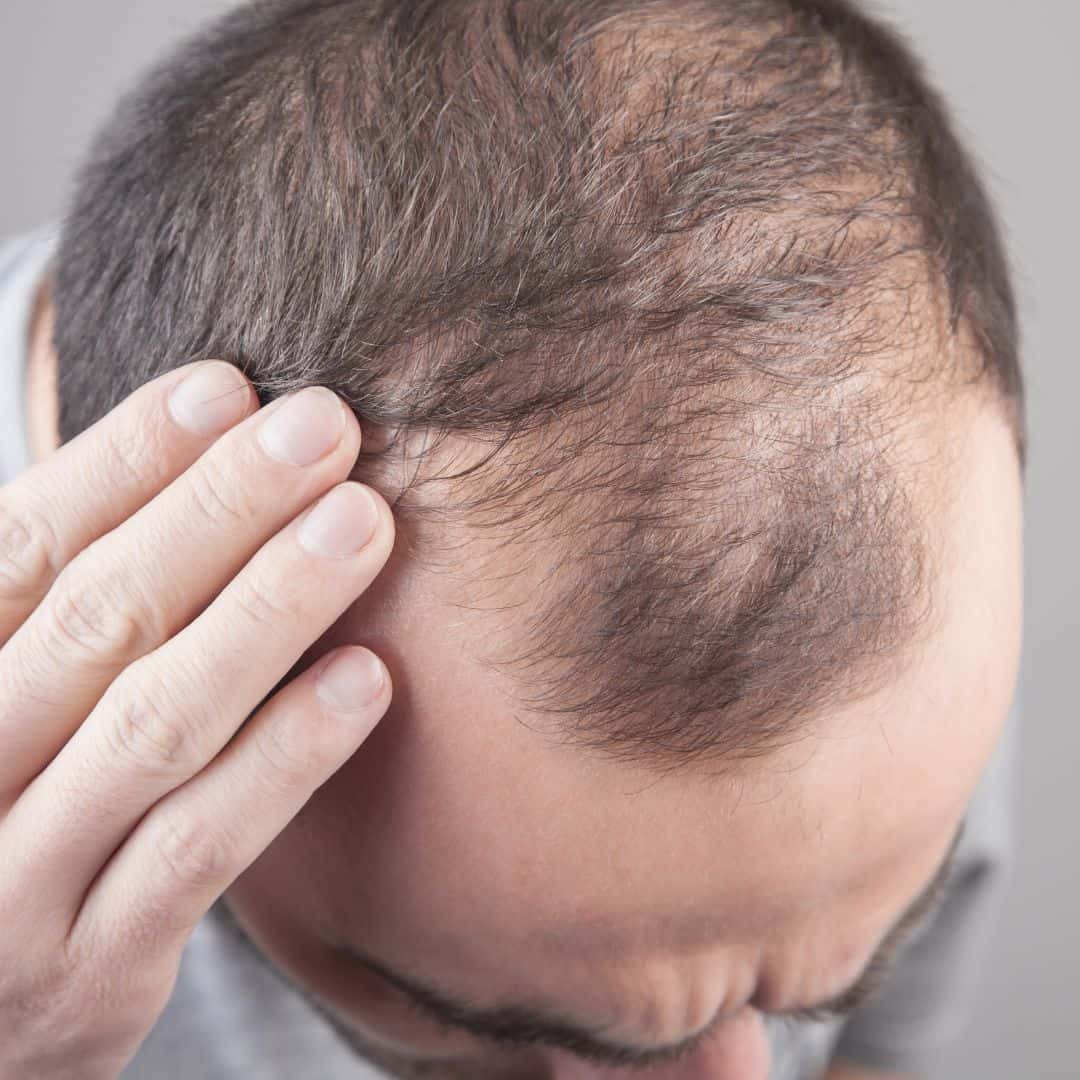 Hand resting on a man's thinning crown