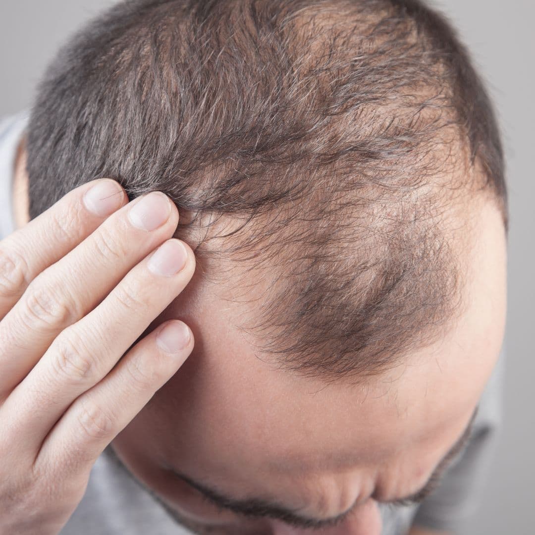 Thinning hair on the crown and hairline, seen from above