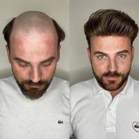 Before and after a professionally fitted men's hairpiece