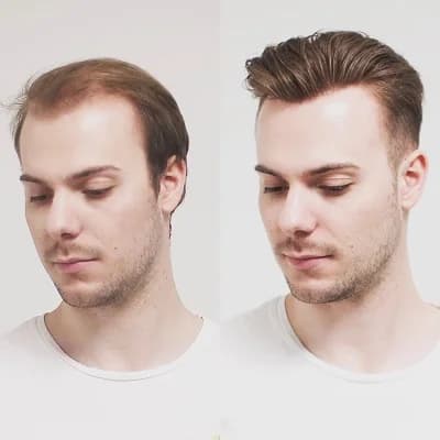 Non-Surgical Hair Replacement