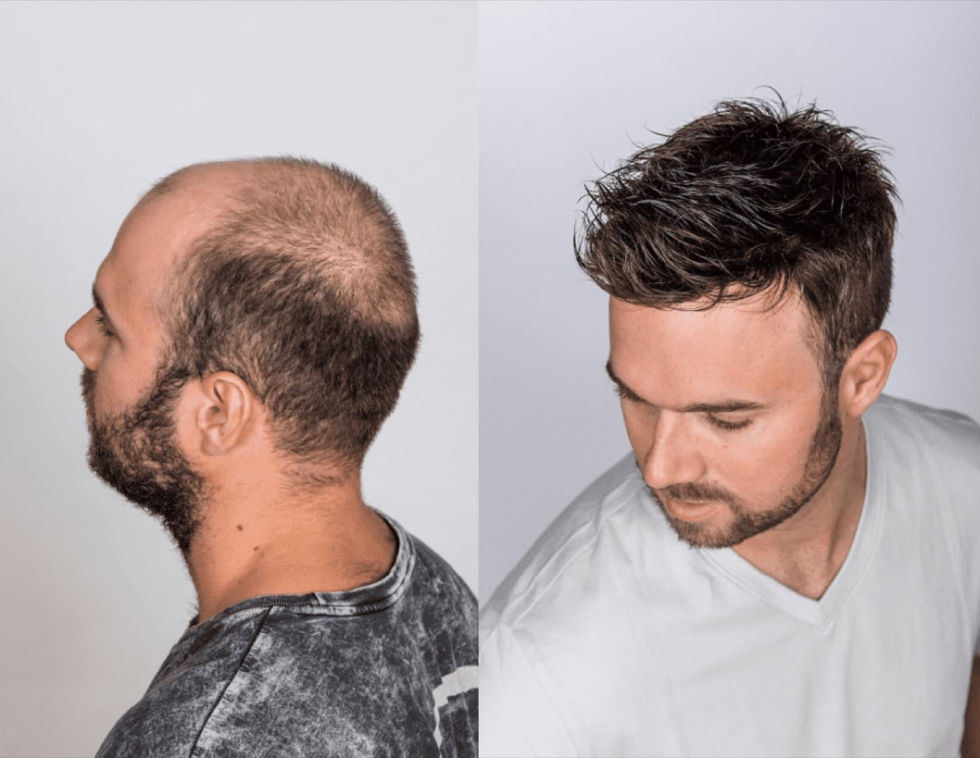 Crown coverage before and after non-surgical hair replacement