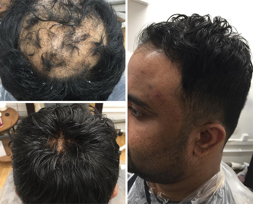 7 Stages Of Male Pattern Balding